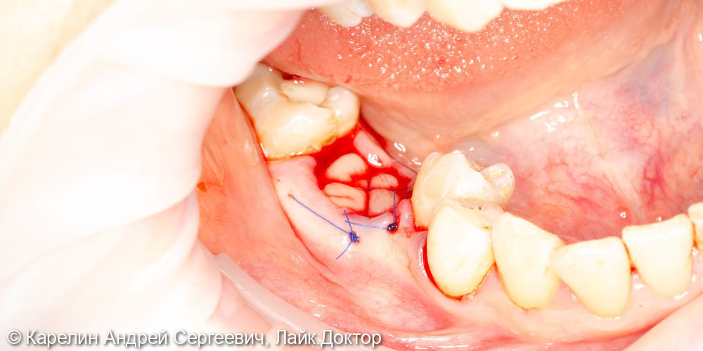 Одномоментная с удалением имплантация в области зуба 4.6 - фото №7