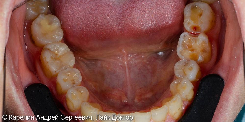Композитная реставрация нижних жевательных зубов - фото №1