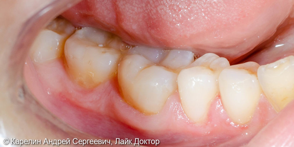 Композитная реставрация нижних жевательных зубов - фото №3