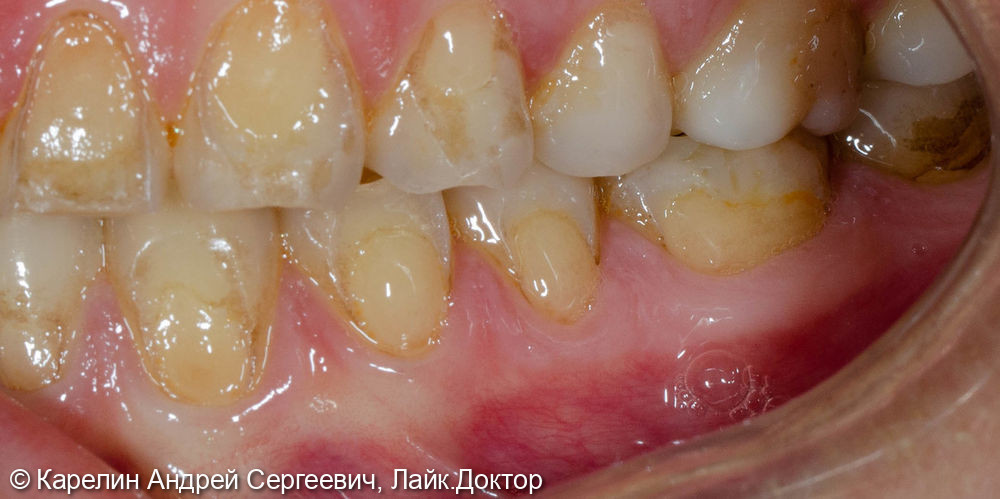 Композитная реставрация нижних жевательных зубов - фото №4