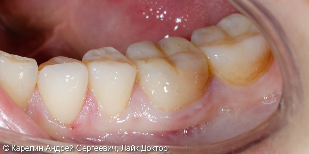 Композитная реставрация нижних жевательных зубов - фото №5