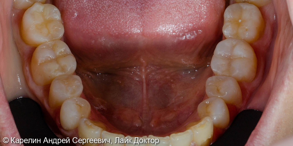 Композитная реставрация нижних жевательных зубов - фото №6