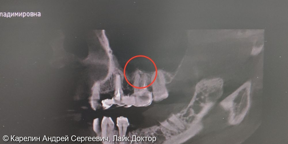 Лечение хронического гранулирующего периодонтита зуба 1.6 - фото №1