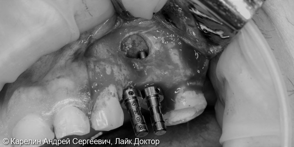 Одномоментный синуслифтинг с установкой 2 имплантатов 2.4,2.5 и удаление инородного материала из Гайморовой пазухи - фото №4