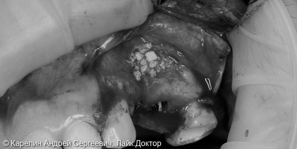 Одномоментный синуслифтинг с установкой 2 имплантатов 2.4,2.5 и удаление инородного материала из Гайморовой пазухи - фото №5