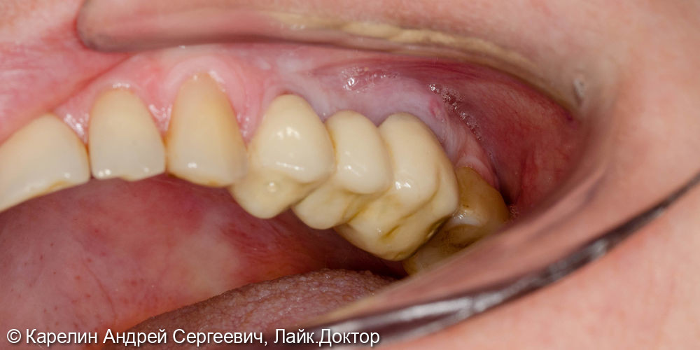 Атравматическое удаление зуба 2.6 - фото №1