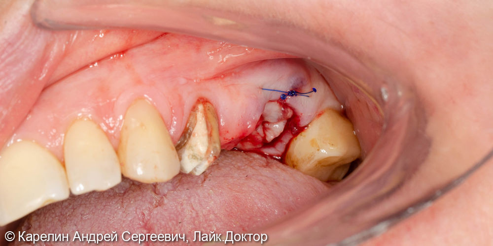 Атравматическое удаление зуба 2.6 - фото №4