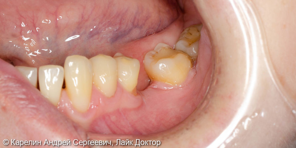 Имплантация с одномоментной нагрузкой в области зуба 3.6 - фото №1