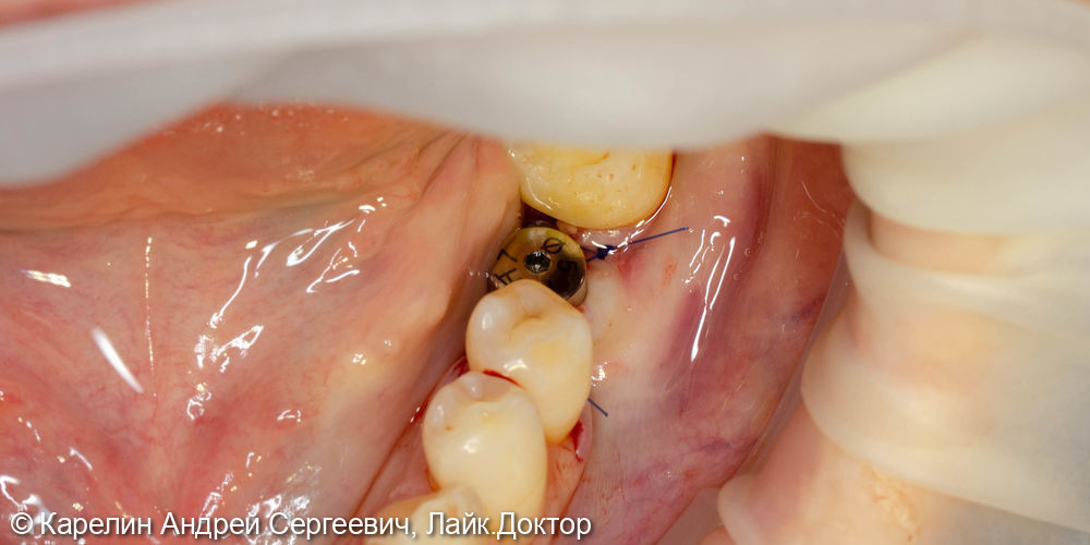 Имплантация с одномоментной нагрузкой в области зуба 3.6 - фото №2