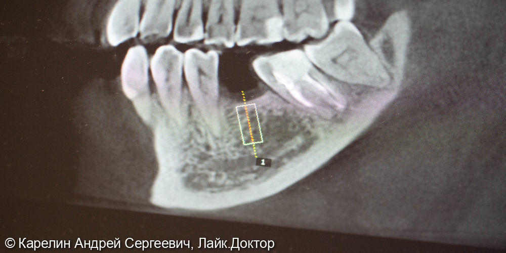 Имплантация с одномоментной нагрузкой в области зуба 3.6 - фото №5