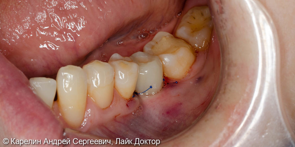 Имплантация с одномоментной нагрузкой в области зуба 3.6 - фото №7