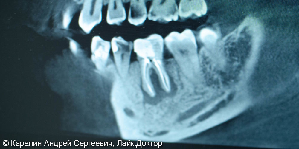 Атравматическое удаление зуба 3.6 под имплантацию - фото №2