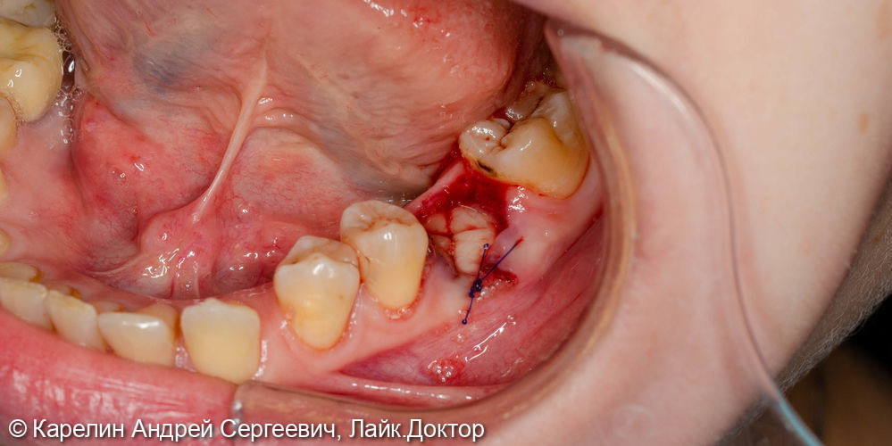 Атравматическое удаление зуба 3.6 под имплантацию - фото №4