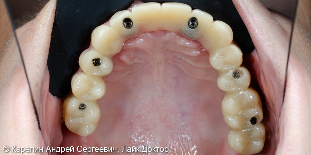 Тотальная реконструкция верхней челюсти на 6 имплантатах - фото №3