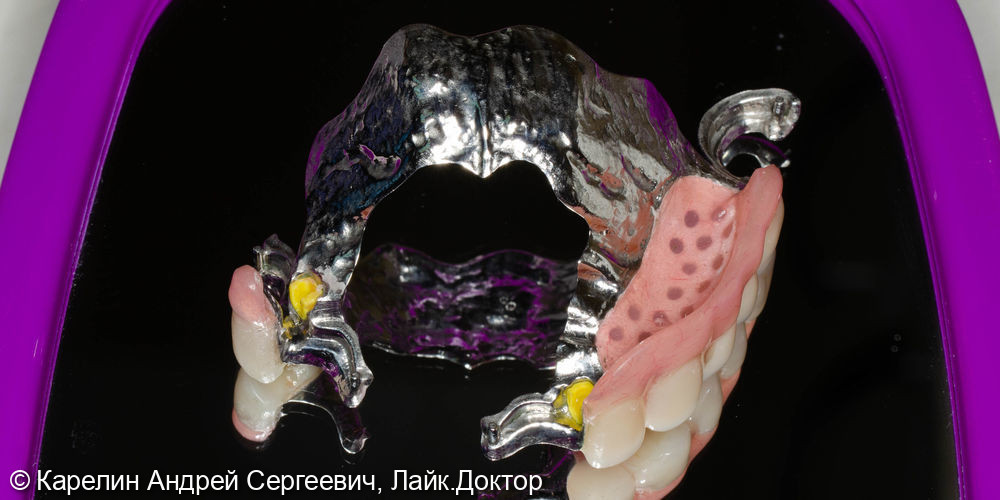 Реконструкция зубочелюстной системы металлокерамическими коронками и бюгельными протезами - фото №8