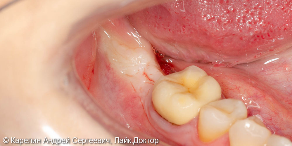 Полный протокол от имплантации до протезирования зуба 4.7 - фото №1