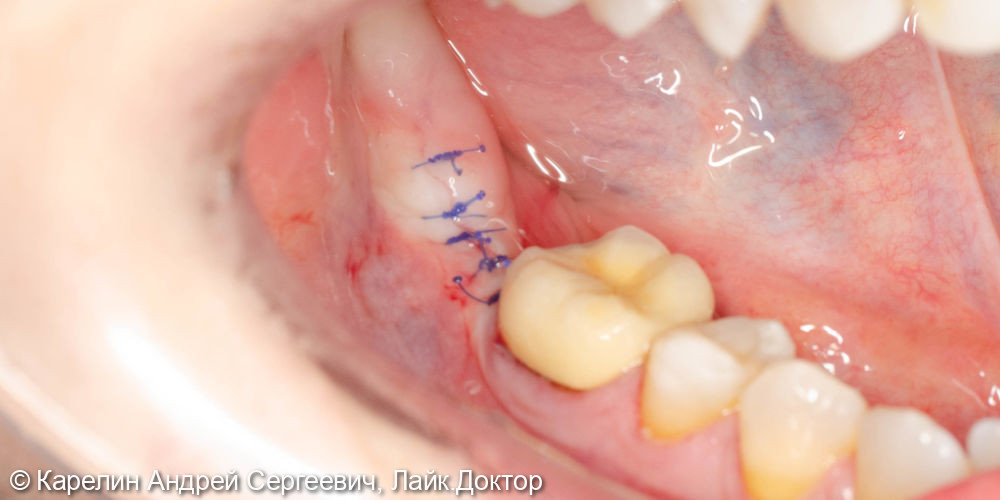Полный протокол от имплантации до протезирования зуба 4.7 - фото №2