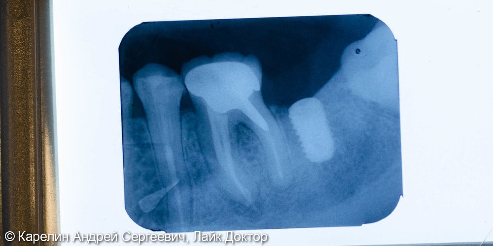 Полный протокол от имплантации до протезирования зуба 4.7 - фото №3