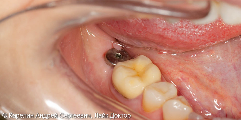 Полный протокол от имплантации до протезирования зуба 4.7 - фото №4
