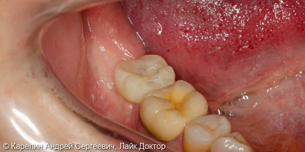Полный протокол от имплантации до протезирования зуба 4.7 - фото №6