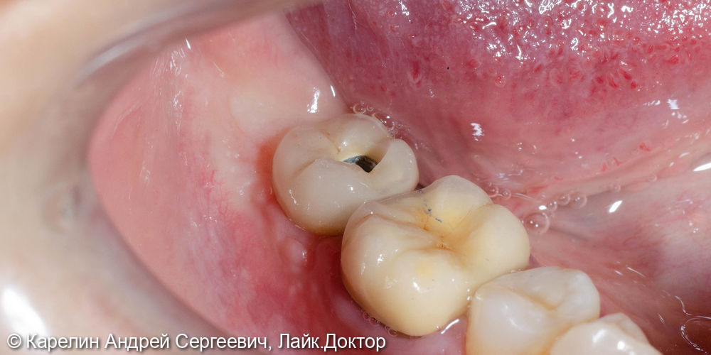 Полный протокол от имплантации до протезирования зуба 4.7 - фото №7