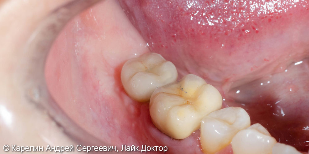 Полный протокол от имплантации до протезирования зуба 4.7 - фото №8