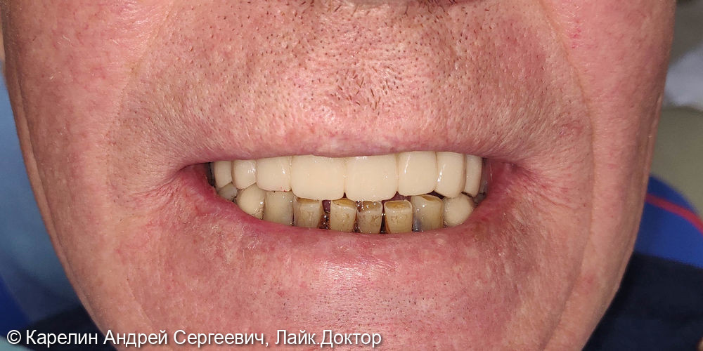 Тотальная реабилитация зубочелюстной системы с помощью съёмных конструкций на имплантатах и на зубах - фото №1