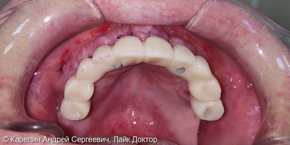 Тотальная реабилитация зубочелюстной системы с помощью съёмных конструкций на имплантатах и на зубах - фото №3
