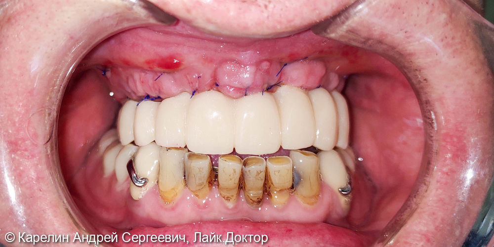 Тотальная реабилитация зубочелюстной системы с помощью съёмных конструкций на имплантатах и на зубах - фото №4