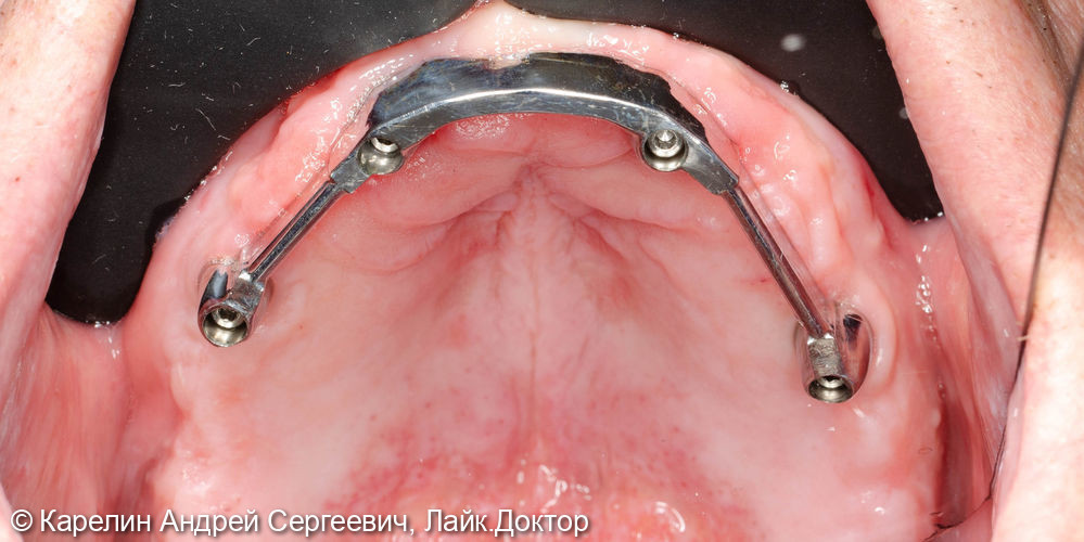 Тотальная реабилитация зубочелюстной системы с помощью съёмных конструкций на имплантатах и на зубах - фото №6