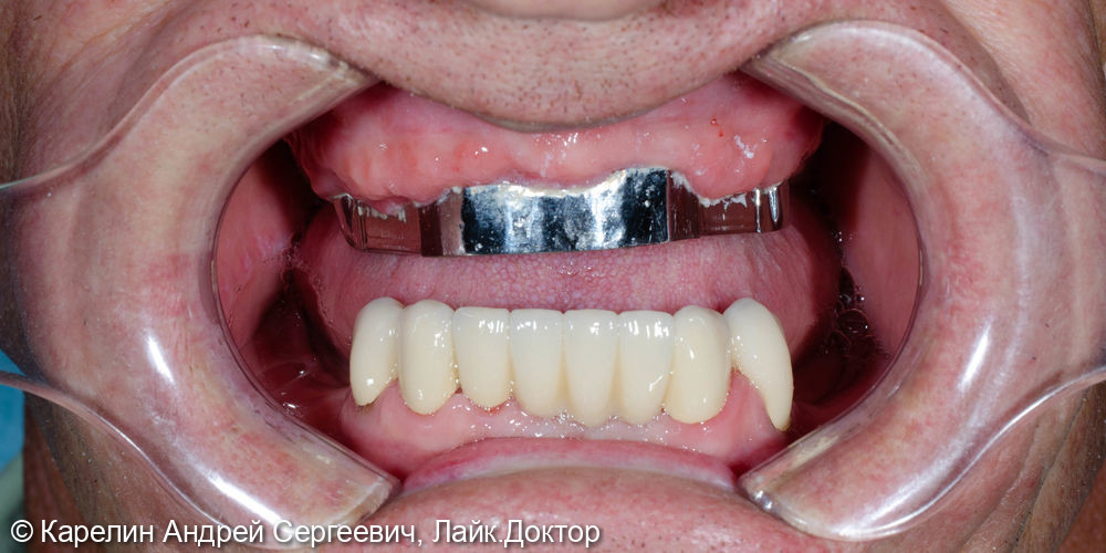 Тотальная реабилитация зубочелюстной системы с помощью съёмных конструкций на имплантатах и на зубах - фото №7