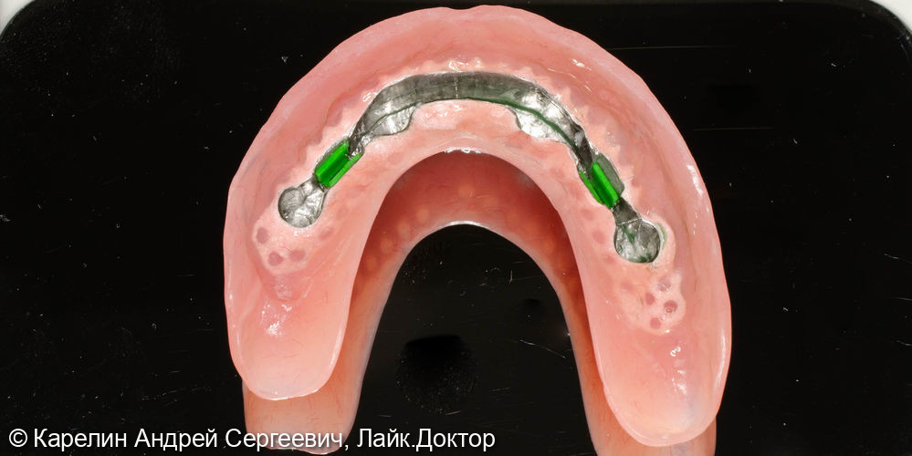 Тотальная реабилитация зубочелюстной системы с помощью съёмных конструкций на имплантатах и на зубах - фото №8