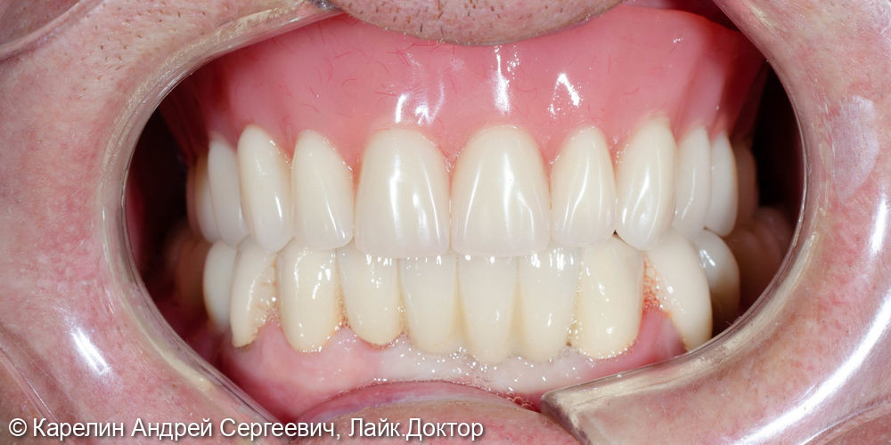 Тотальная реабилитация зубочелюстной системы с помощью съёмных конструкций на имплантатах и на зубах - фото №9