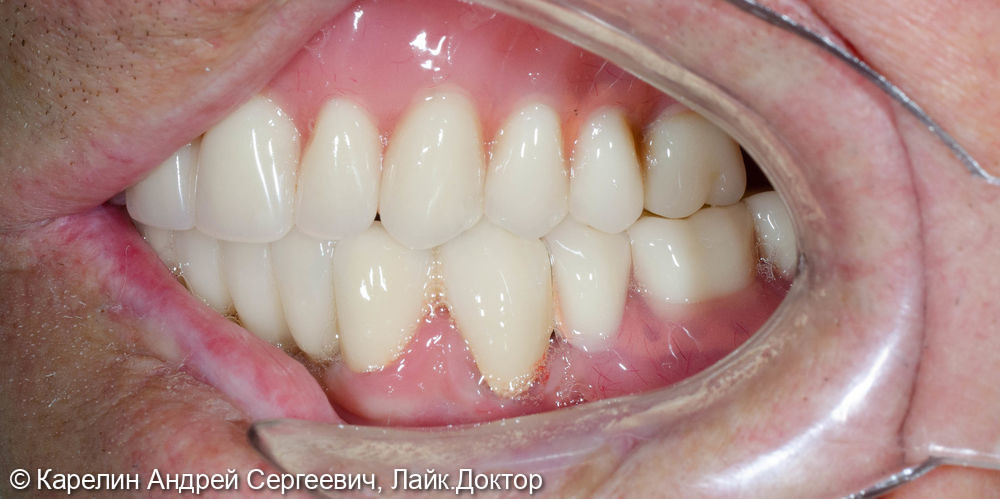 Тотальная реабилитация зубочелюстной системы с помощью съёмных конструкций на имплантатах и на зубах - фото №11