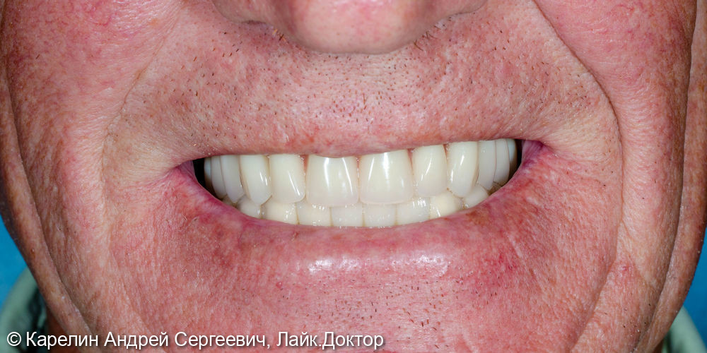 Тотальная реабилитация зубочелюстной системы с помощью съёмных конструкций на имплантатах и на зубах - фото №12