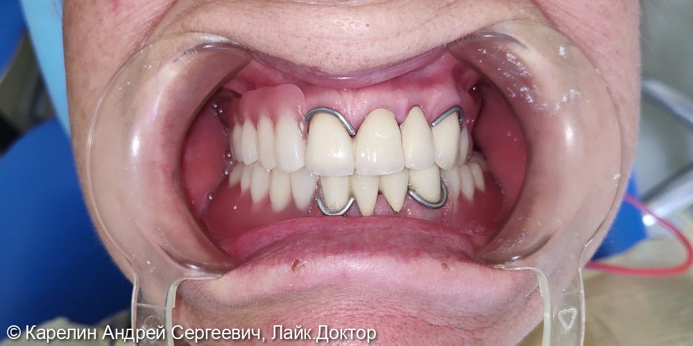 Восстановление зубных рядов с помощью металлокерамических коронок и частных съёмных пластиночных протезов - фото №3