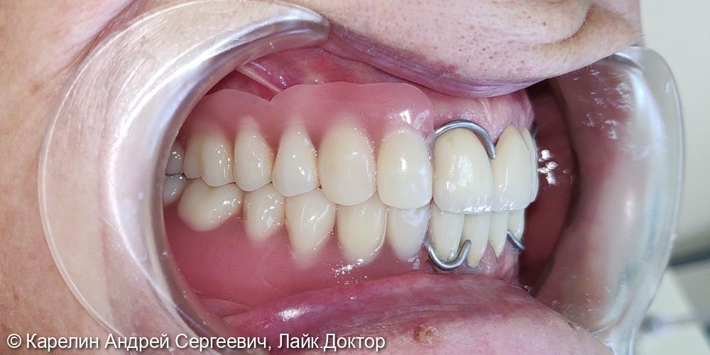 Восстановление зубных рядов с помощью металлокерамических коронок и частных съёмных пластиночных протезов - фото №4