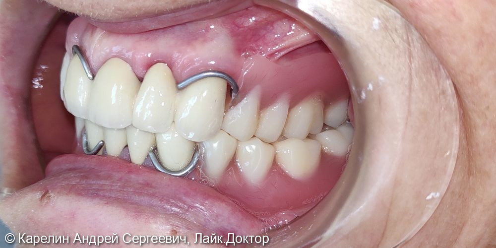 Восстановление зубных рядов с помощью металлокерамических коронок и частных съёмных пластиночных протезов - фото №5