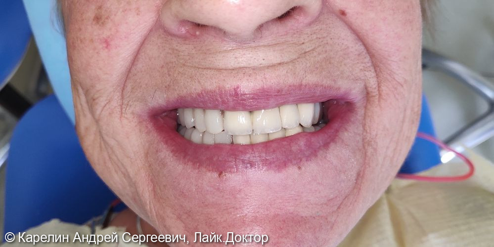 Восстановление зубных рядов с помощью металлокерамических коронок и частных съёмных пластиночных протезов - фото №7