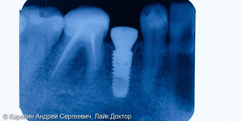 Тотальная реставрация обеих челюстей безметалловыми конструкциями - фото №4