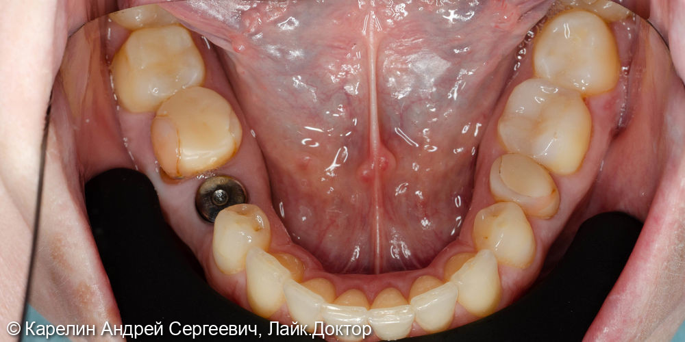 Тотальная реставрация обеих челюстей безметалловыми конструкциями - фото №9