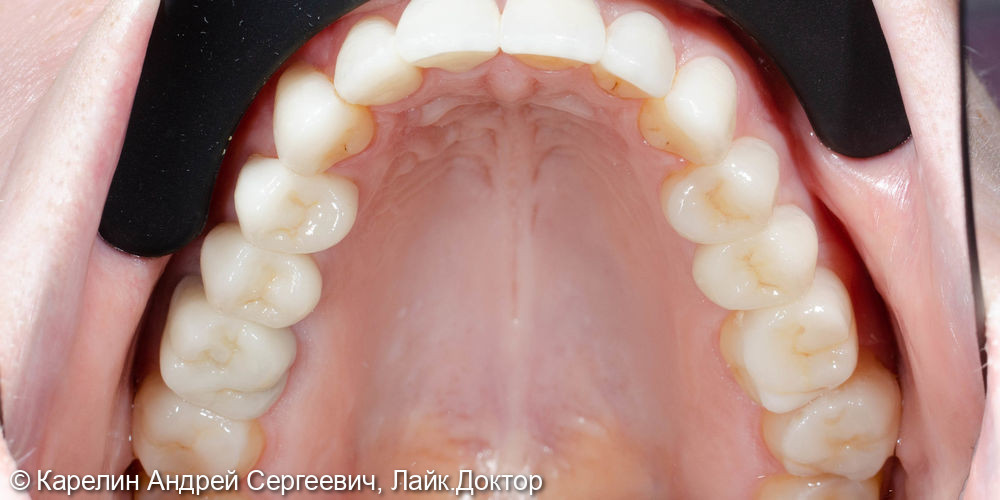 Тотальная реставрация обеих челюстей безметалловыми конструкциями - фото №20