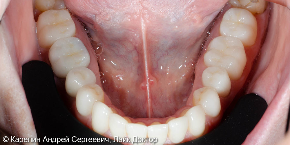 Тотальная реставрация обеих челюстей безметалловыми конструкциями - фото №21