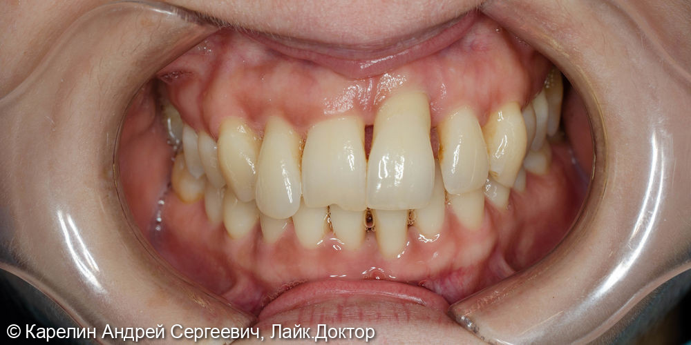Одномоментная имплантация в области фронтальных зубов верхней челюсти - фото №1
