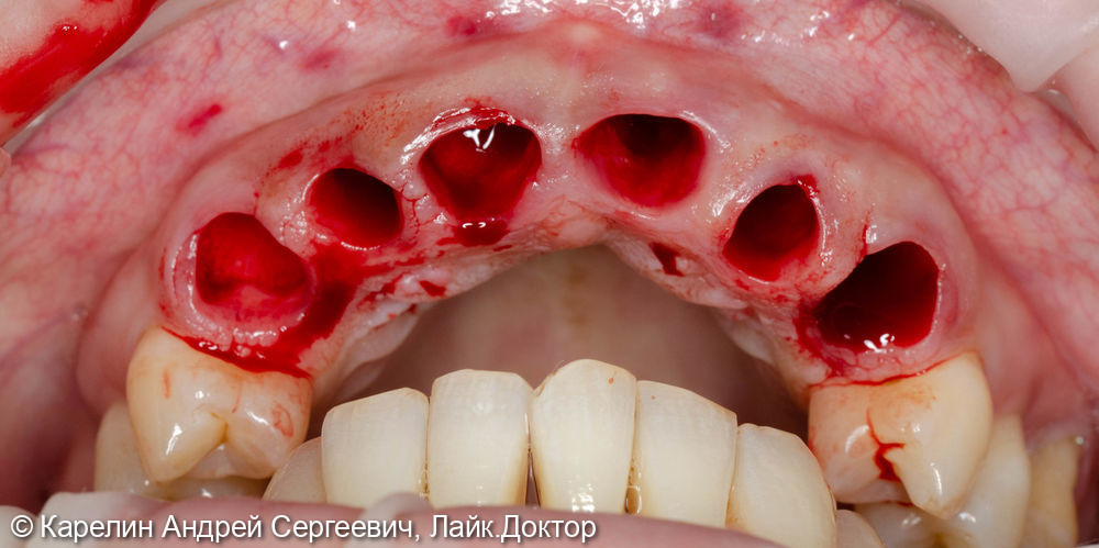 Одномоментная имплантация в области фронтальных зубов верхней челюсти - фото №2