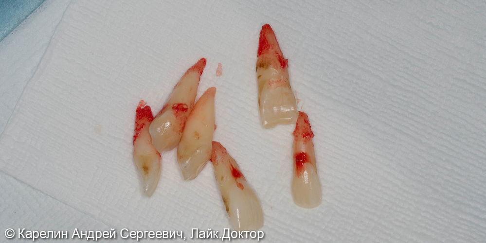 Одномоментная имплантация в области фронтальных зубов верхней челюсти - фото №4