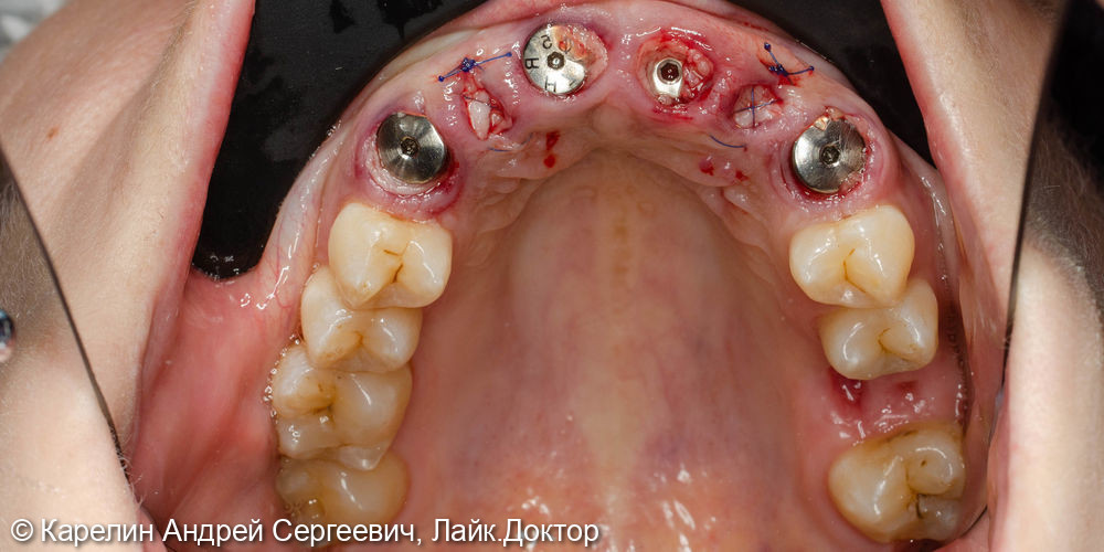 Одномоментная имплантация в области фронтальных зубов верхней челюсти - фото №5