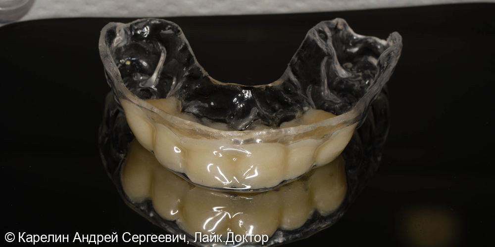Одномоментная имплантация в области фронтальных зубов верхней челюсти - фото №6