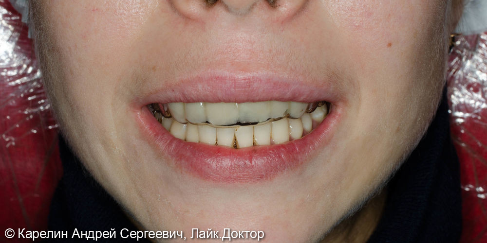 Одномоментная имплантация в области фронтальных зубов верхней челюсти - фото №7