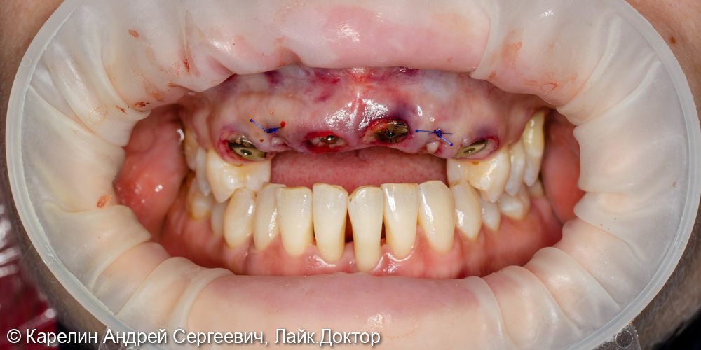 Одномоментная имплантация в области фронтальных зубов верхней челюсти - фото №8